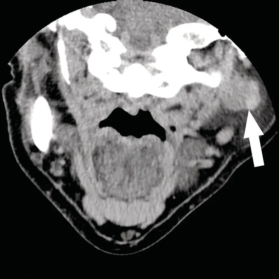 Figure 266 Reformatted coronal contrastenhanced CT demonstrating an - фото 86