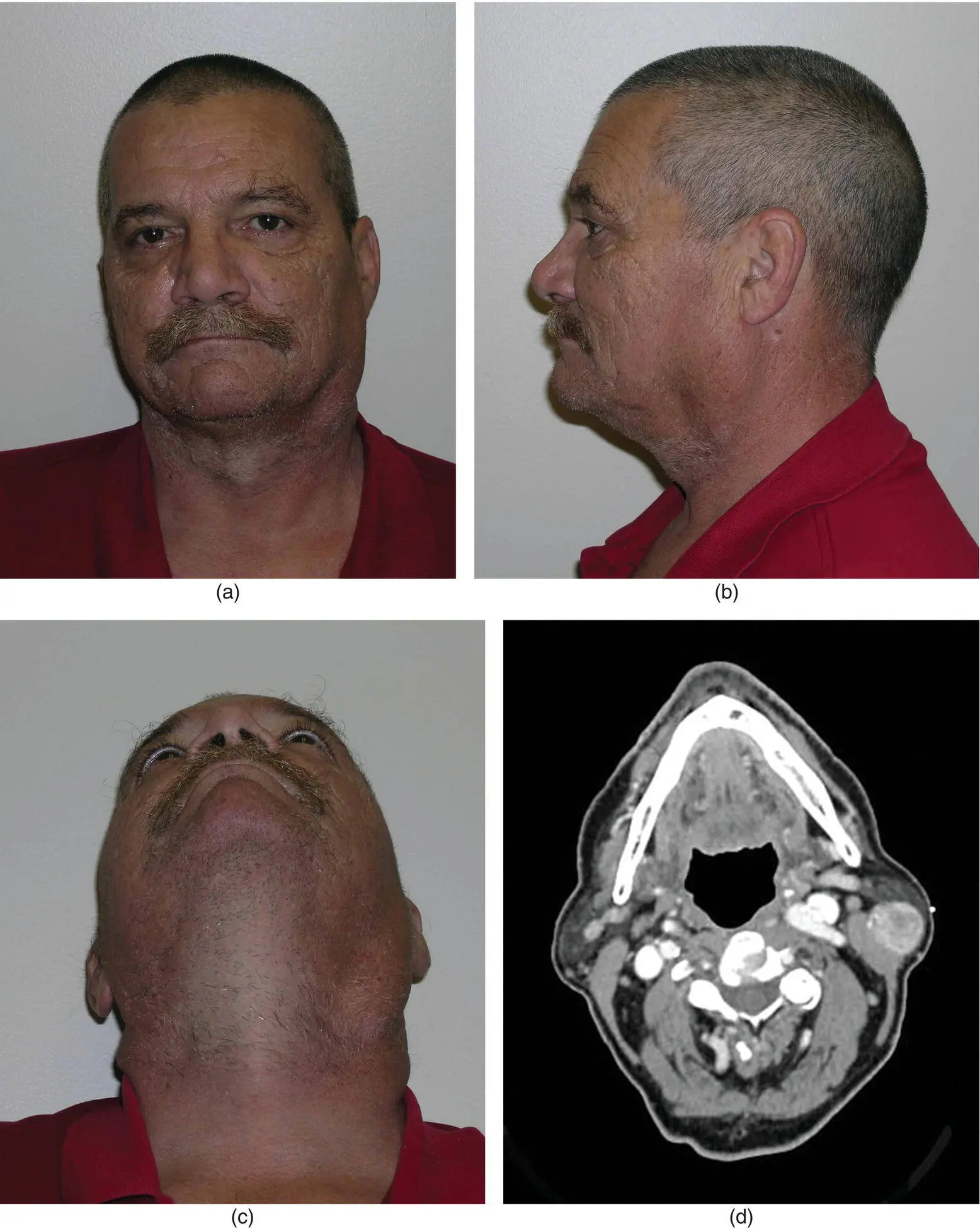 Salivary Gland Pathology - фото 105