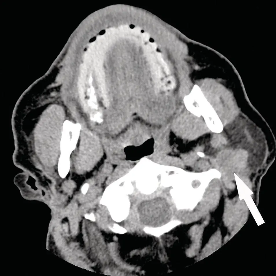 Figure 264 Axial contrastenhanced CT demonstrating an illdefined mass - фото 84