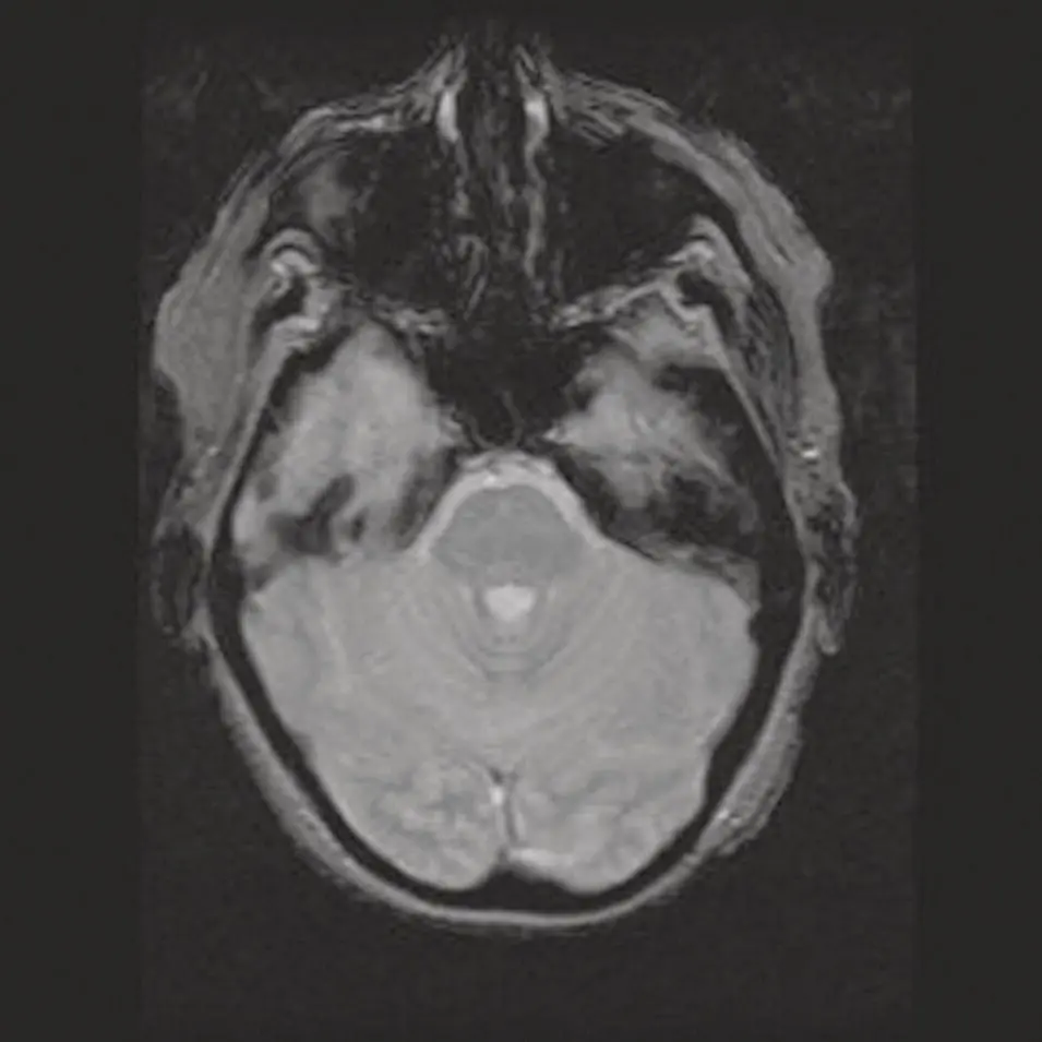 Figure 210 Axial MRI GRE image Figure 211 Axial MRI STIR image at the - фото 30
