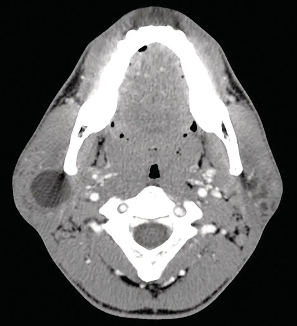 Figure 255 Axial CT demonstrating a large cystic lesion in the right parotid - фото 75