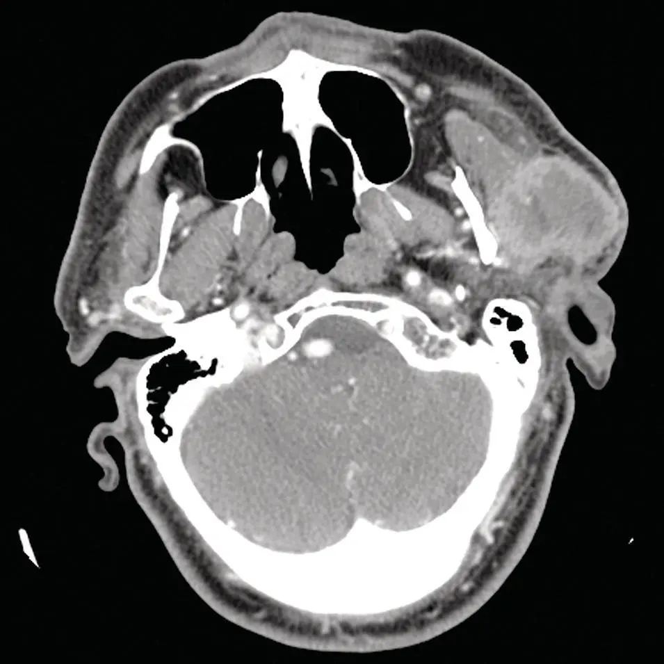 Figure 284 Axial contrastenhanced CT scan through the parotid glands - фото 104