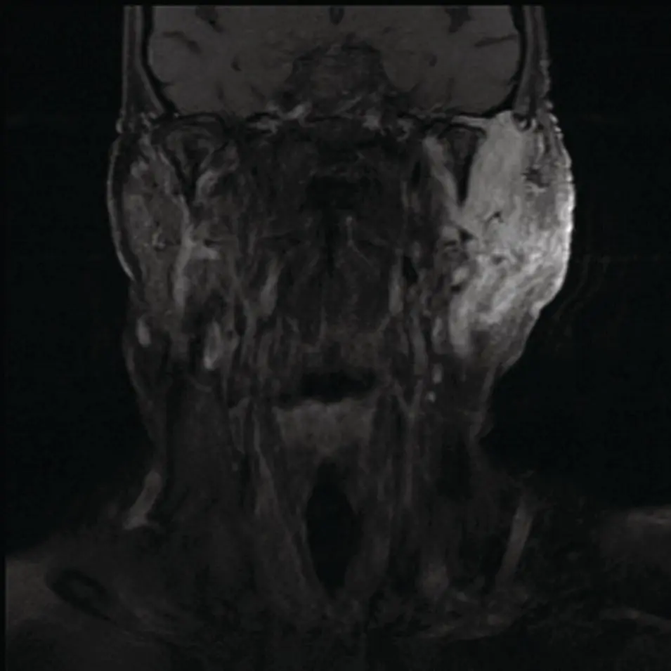 Figure 277 Coronal T1 contrast image showing a very illdefined mass with - фото 97
