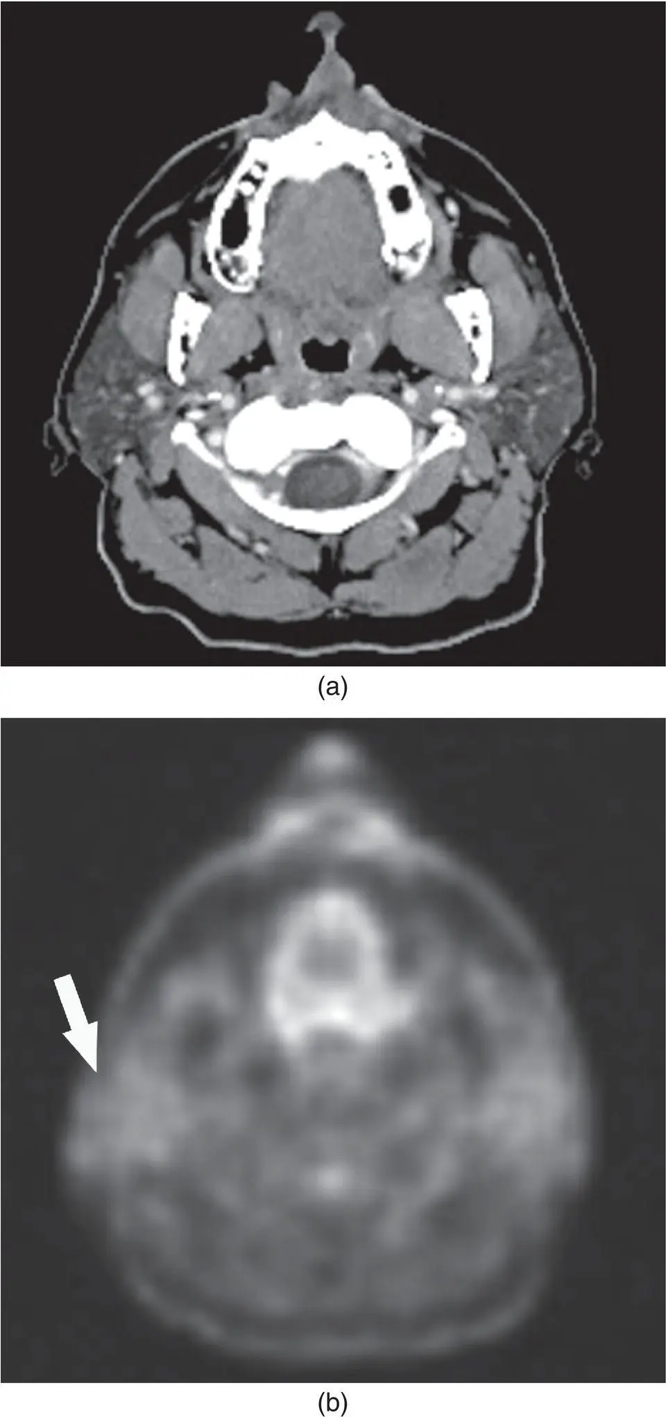 Figure 228 CT a and PET b images in axial plane demonstrating normal - фото 48
