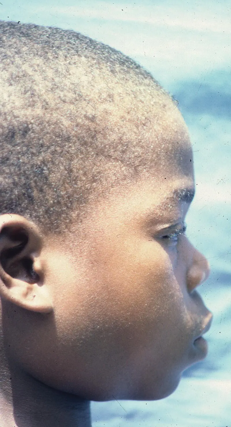 Figure 319 A 6yearold African female with AIDS showing involvement of the - фото 136