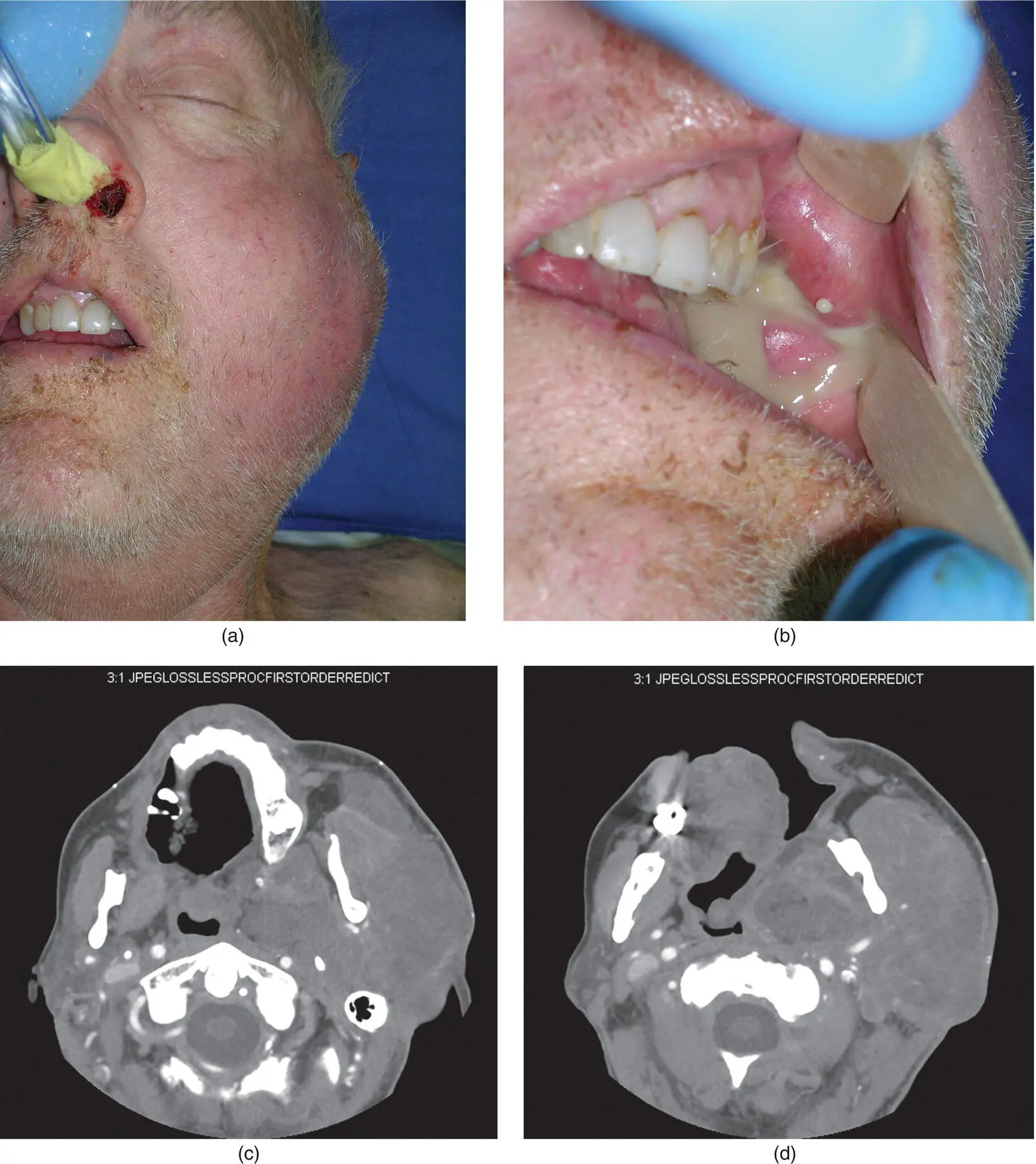 Figure 321 A 71yearold man a demonstrated significant left facial - фото 138