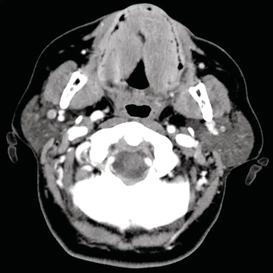 Figure 230 Axial CT of the neck demonstrates the intermediate to low density - фото 50