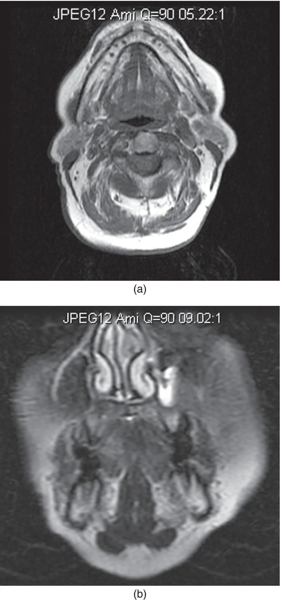 Figure 245Axial contrastenhanced T1 MRI of the sublingual gland - фото 65