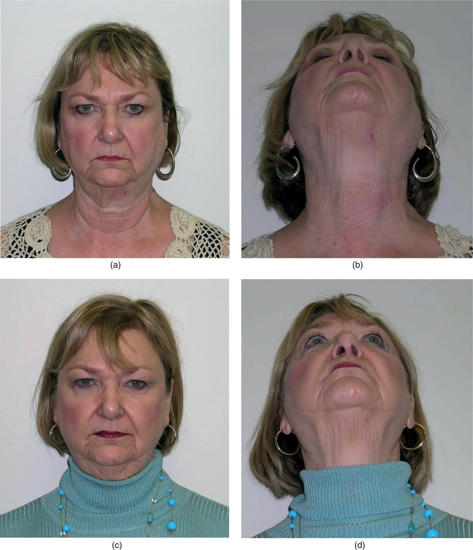 Figure 31 A 55yearold woman a and b with a oneweek history of pain and - фото 111