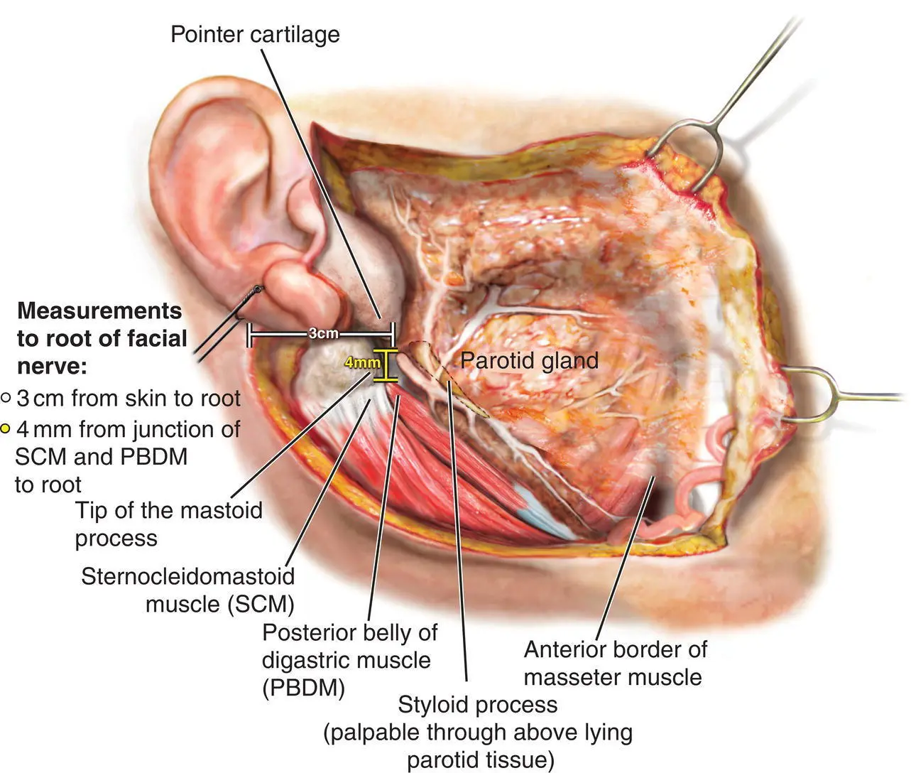 Figure 14 Anatomical landmarks of the extratemporal facial nerve Figure - фото 9