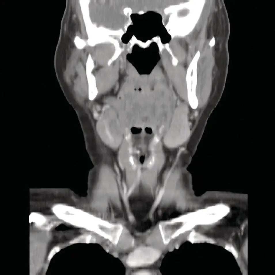 Figure 25 Coronal CT reformation of the neck in softtissue window at the - фото 25