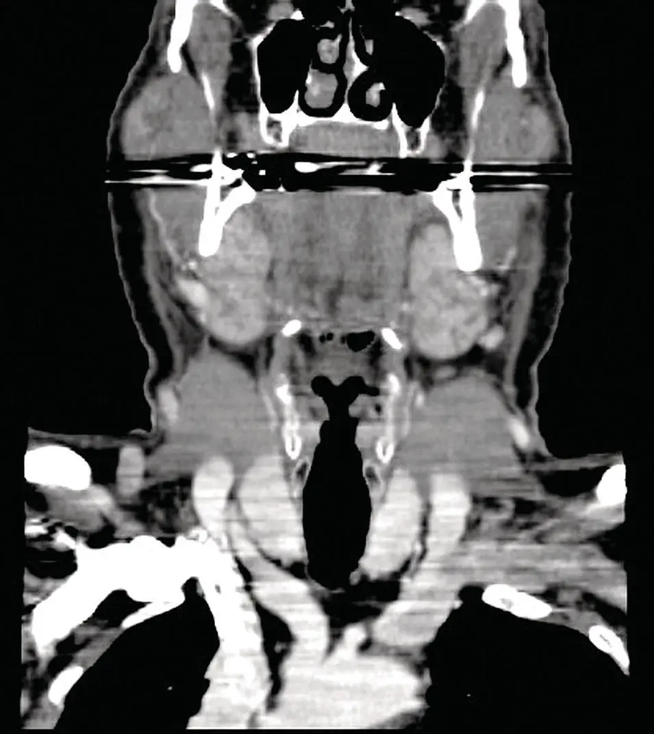 Figure 254 Reformatted coronal CT demonstrating enlargement and enhancement - фото 74
