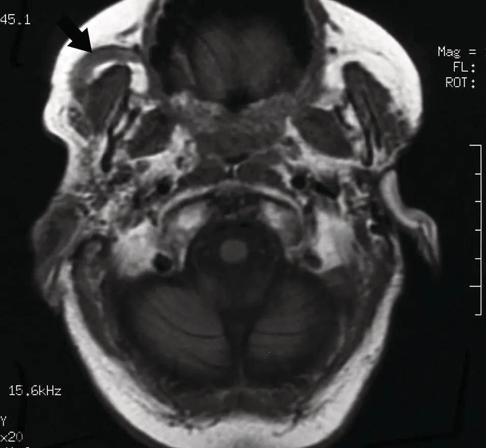 Figure 28 Axial MRI T1 weighted image at level of the skull base and - фото 28