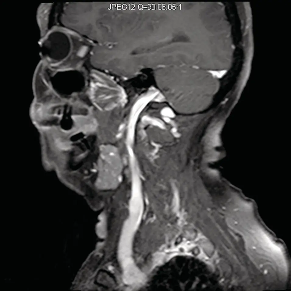 Figure 242Sagittal T1 fat saturated MRI of the submandibular gland - фото 62