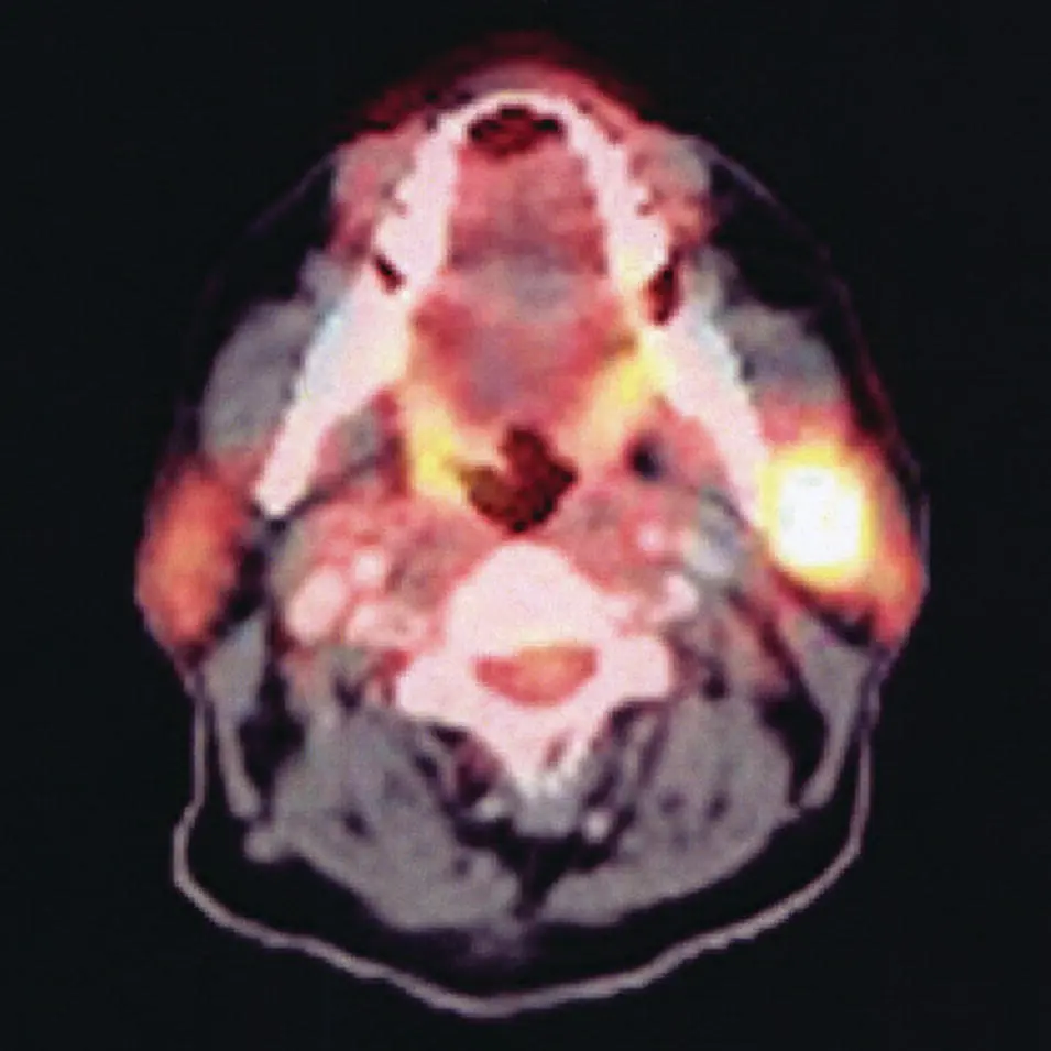 Figure 281 Fused axial PETCT image corresponding to the case illustrated in - фото 101