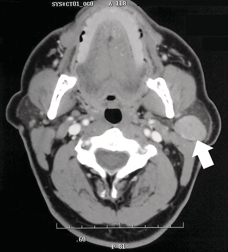 Figure 261 Axial contrastenhanced CT of the parotid gland with a - фото 81