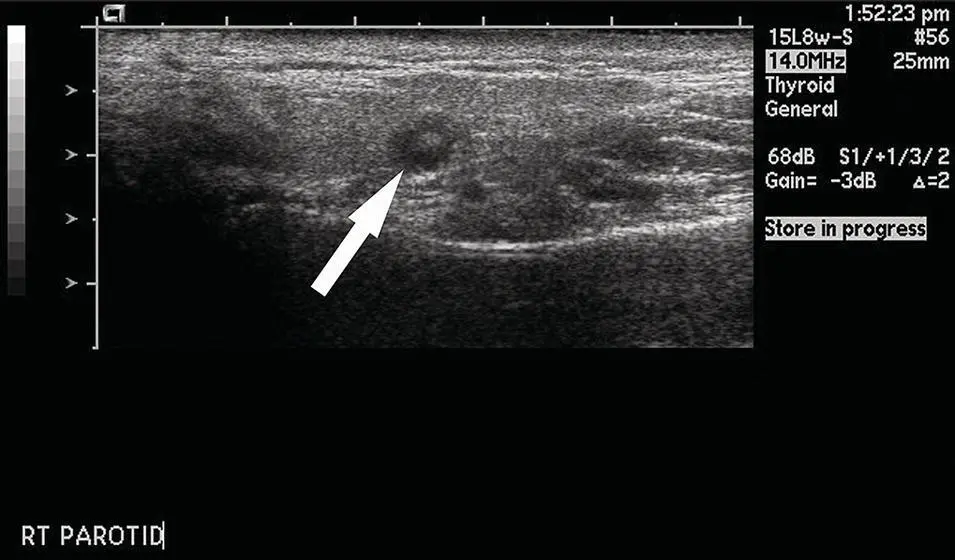 Figure 217 Ultrasound of the parotid gland demonstrating a normal - фото 37