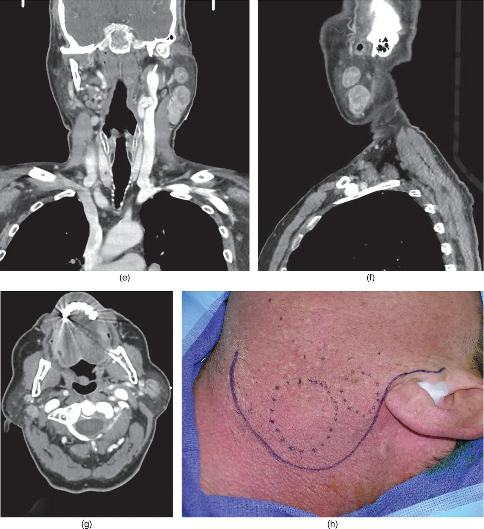 Salivary Gland Pathology - фото 106