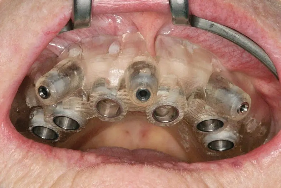 Figure 33 Guided surgery in a full arch implant rehabilitation Further - фото 6
