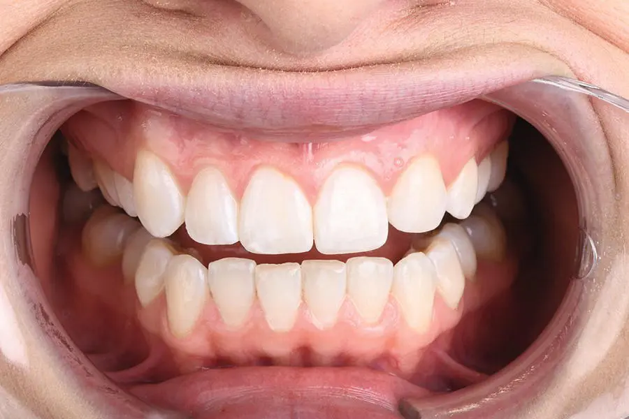 Figure 38 Retracted frontal shot with teeth apart Figure 39 Retracted - фото 11