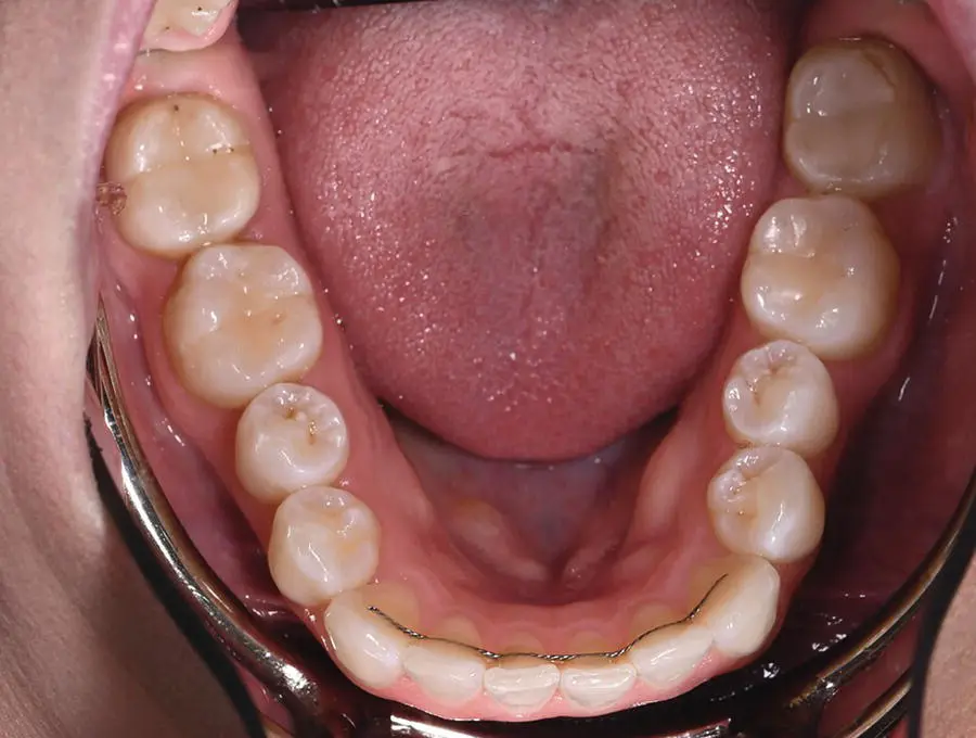 Figure 312 Occlusal photograph of mandibular teeth using a photographic - фото 15