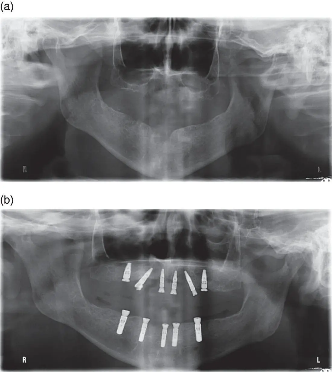 Figure 74 Implant placement following maxillary sinus augmentation in a staged - фото 33