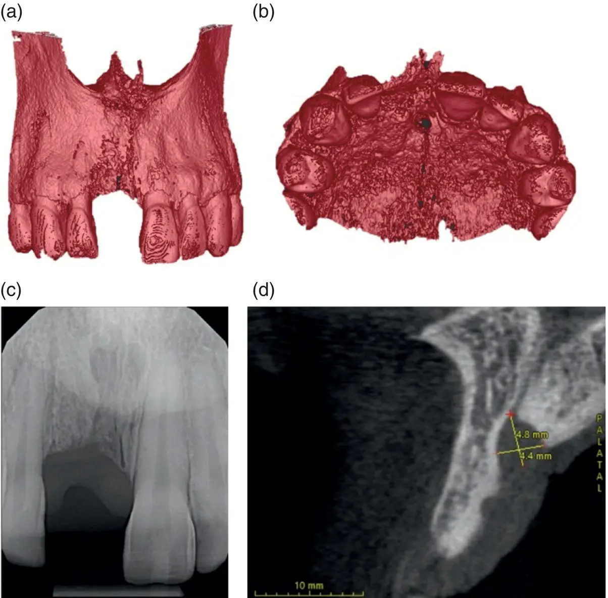 Figure 71 Threedimensional versus twodimensional view of incisive foramen A - фото 30