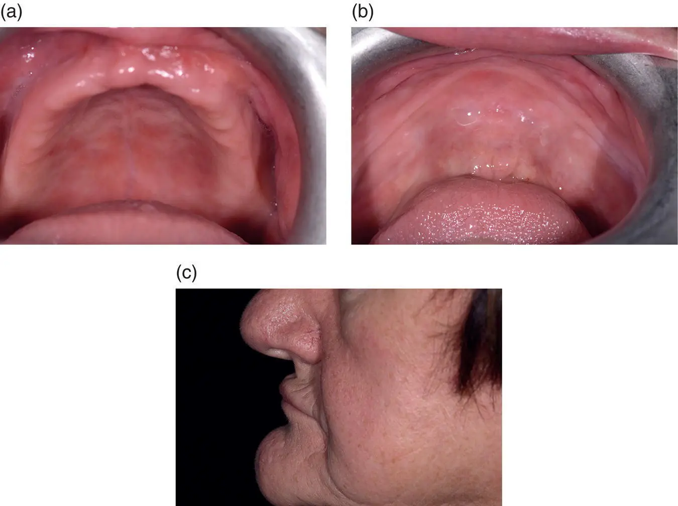 Figure 55 Loss of vertical dimension and facial soft tissue support a b - фото 22