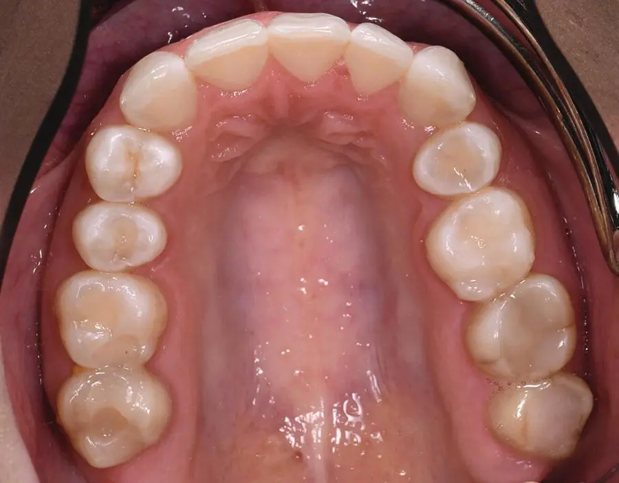 Figure 313 Occlusal photograph of maxillary teeth using a photographic mirror - фото 16