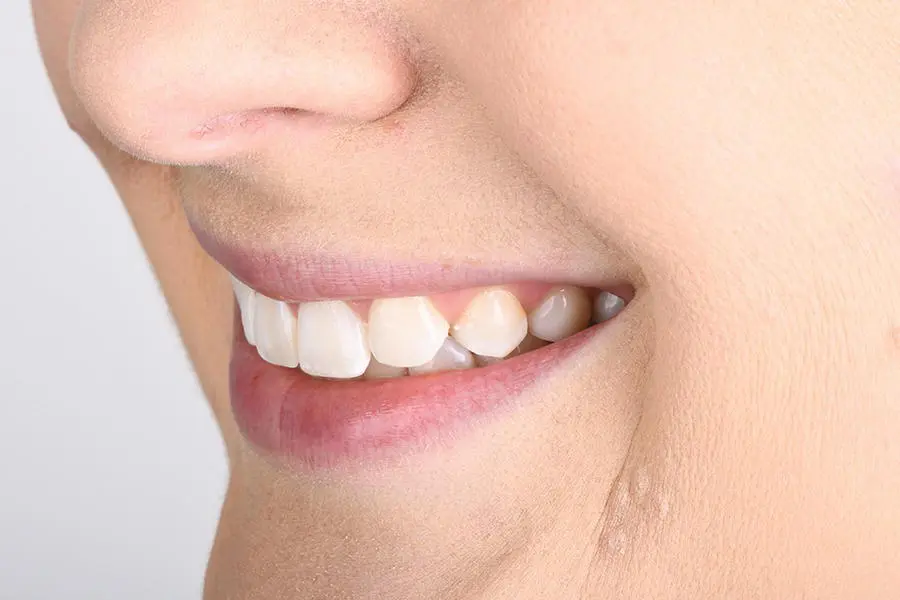 Figure 37 Left lateral smile Figure 38 Retracted frontal shot with teeth - фото 10