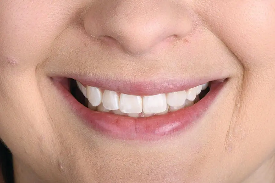 Figure 36Frontal smile Figure 37 Left lateral smile - фото 9