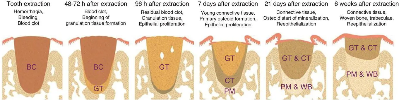 Figure 53 Progressive healing of extraction socket BC blood clot GT - фото 20