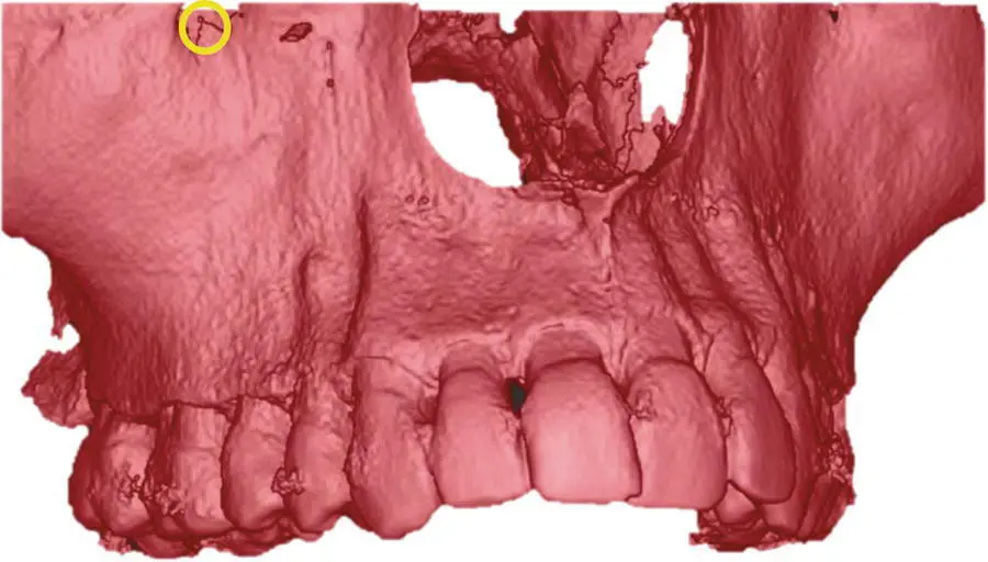 Figure 72 Location of the infraorbital foramen The location of the - фото 31