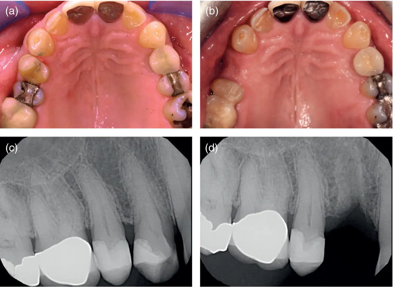 Figure 54 Hard and soft tissue healing of a single tooth extraction a - фото 21