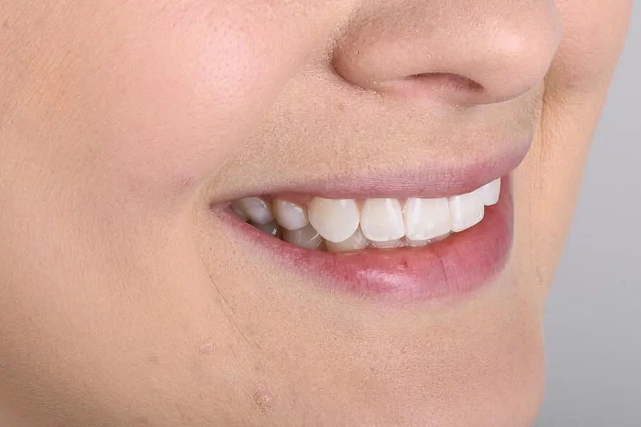 Figure 35 Right lateral smile Figure 36Frontal smile - фото 8