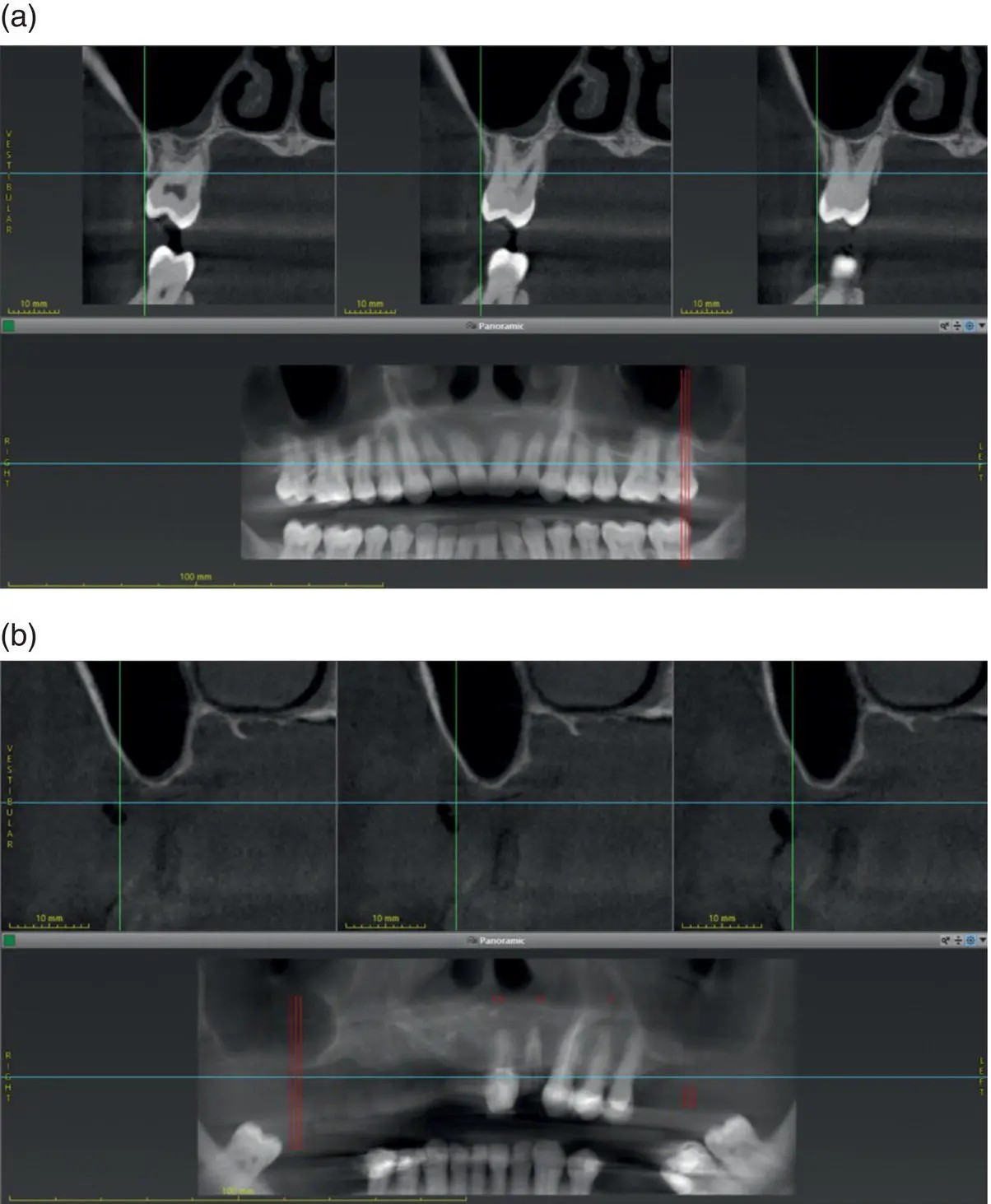 Figure 73 Changes in the presentation of the maxillary sinus a In the - фото 32