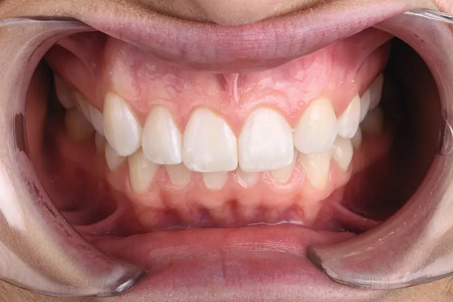 Figure 39 Retracted frontal shot with teeth in maximum intercuspation - фото 12