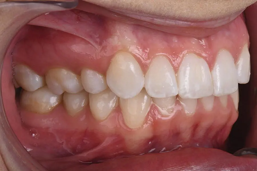 Figure 311 Retracted right photograph displaying right side of teeth The - фото 14