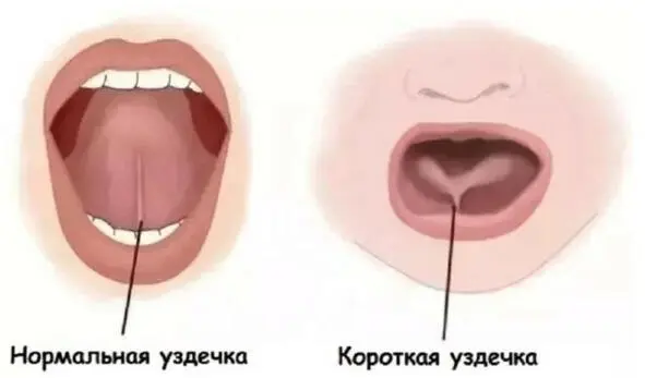 Уздечка языка выглядит как жгутик под языком соединяющий его нижнюю - фото 1