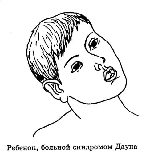 Эта болезнь присуща всем человеческим расам причем признаки синдрома выражены - фото 140