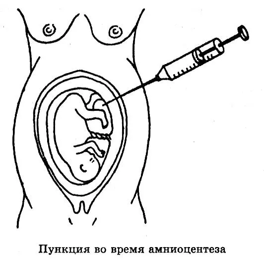 Как поступить если у плода выявлена генетическая предрасположенность к - фото 143