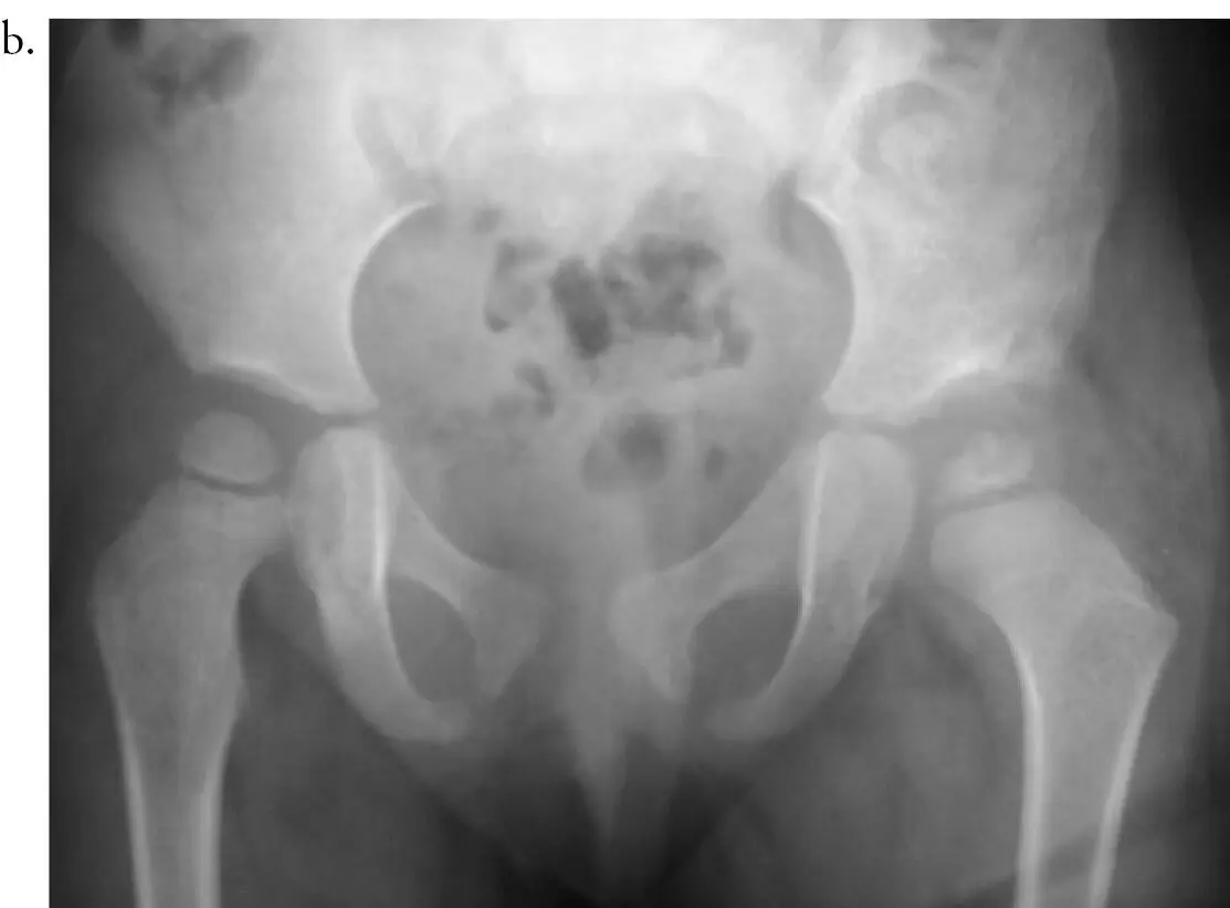En los niños mayores de 3 años debe hacerse siempre osteotomía femoral de - фото 107