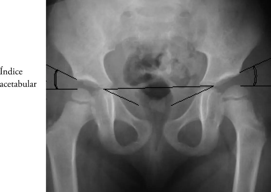 Las líneas deben ser discontinuas para poder evaluar la morfología acetabular - фото 100
