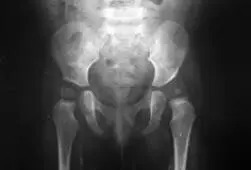 En las caderas luxadas se encuentra pérdida de las relaciones articulares y la - фото 101