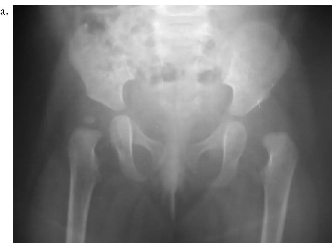 En los niños mayores de 3 años debe hacerse siempre osteotomía femoral de - фото 106