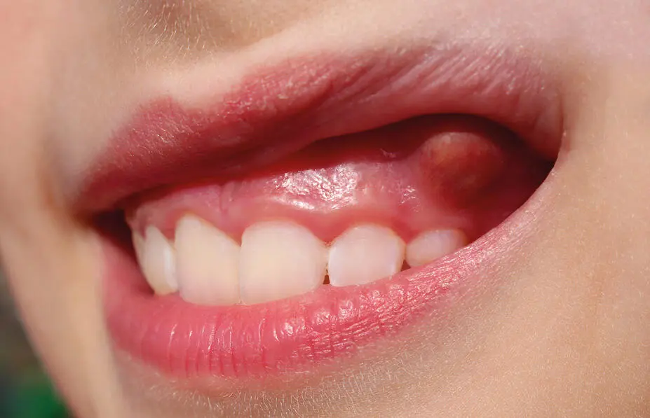 Traumatismos dentoalveolares Es el daño que resulta de una fuerza externa que - фото 126