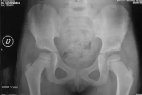 En los niños mayores de 6 años el tratamiento es complejo con tasas de - фото 110