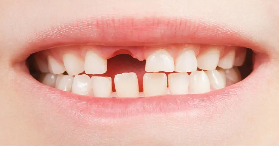 Fractura alveolar Fractura del proceso alveolar que puede involucrar o no al - фото 129