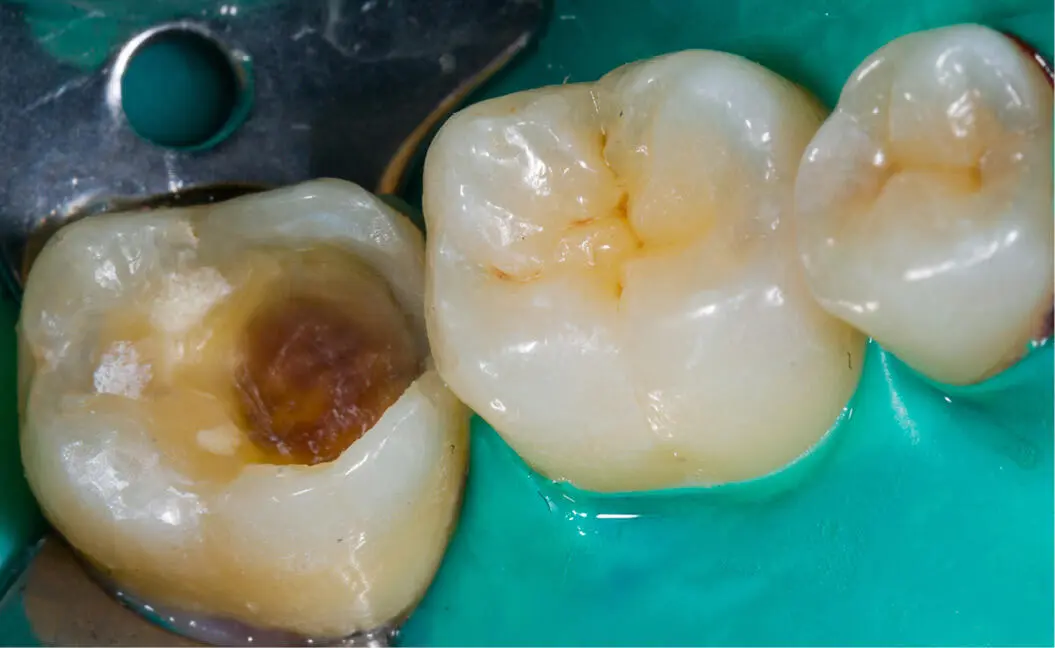 Caries dental de la niñez temprana o caries por biberón Se observa entre los 6 - фото 124