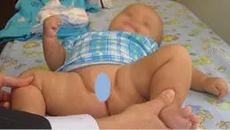 Signo de Galleazzi Al paciente en decúbito supino se le flexionan las caderas - фото 94